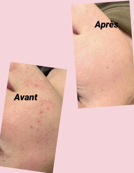 Microneedling est arrivé chez Nail Styl Sylwia & Beauty Nest a Rognac